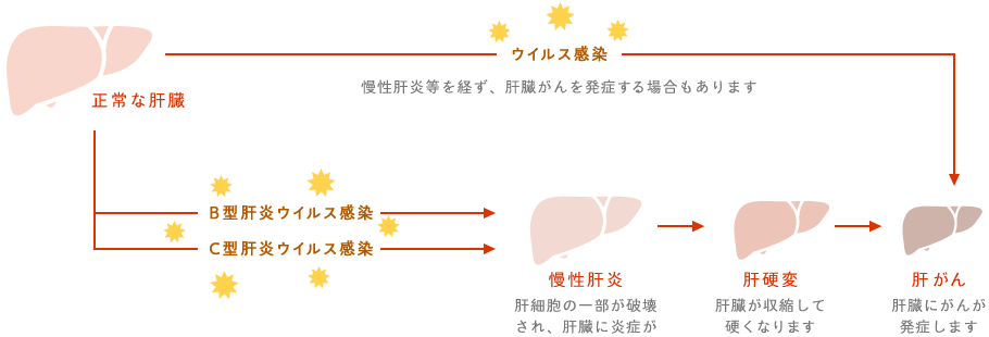 B型肝炎・C型肝炎(ウイルス性肝炎)